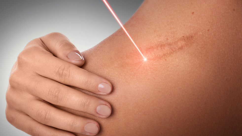 Fraxel Laser Treatment at 4EvaGlow