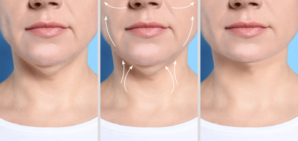 Kybella Before and After Results