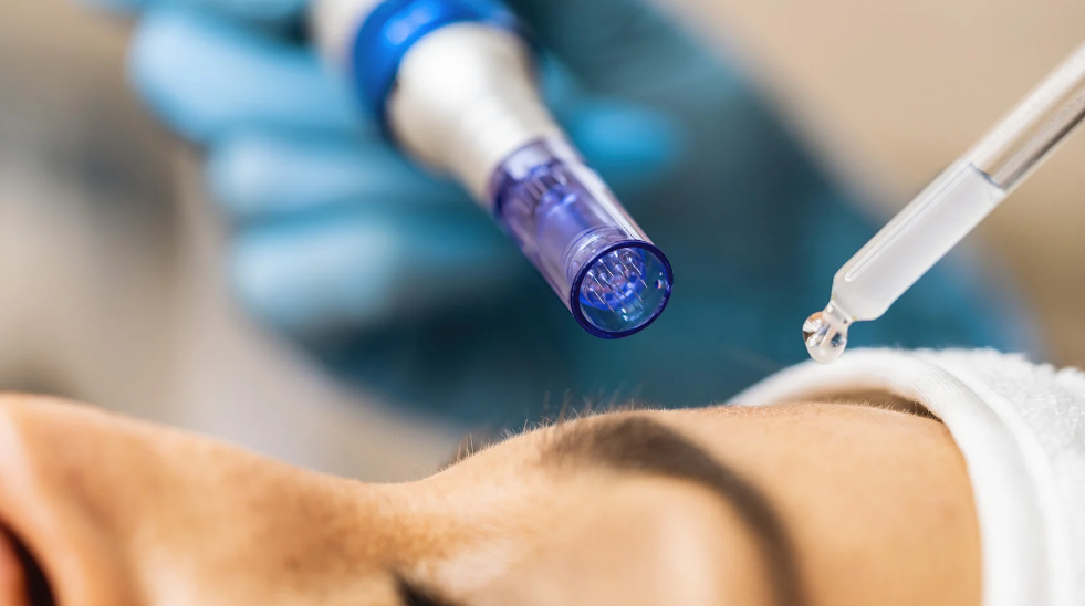 Close-up image of a microneedling procedure being performed on a woman's face.