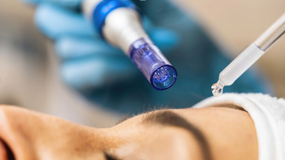 A close-up of a woman receiving microneedling treatment to reduce the appearance of scars.