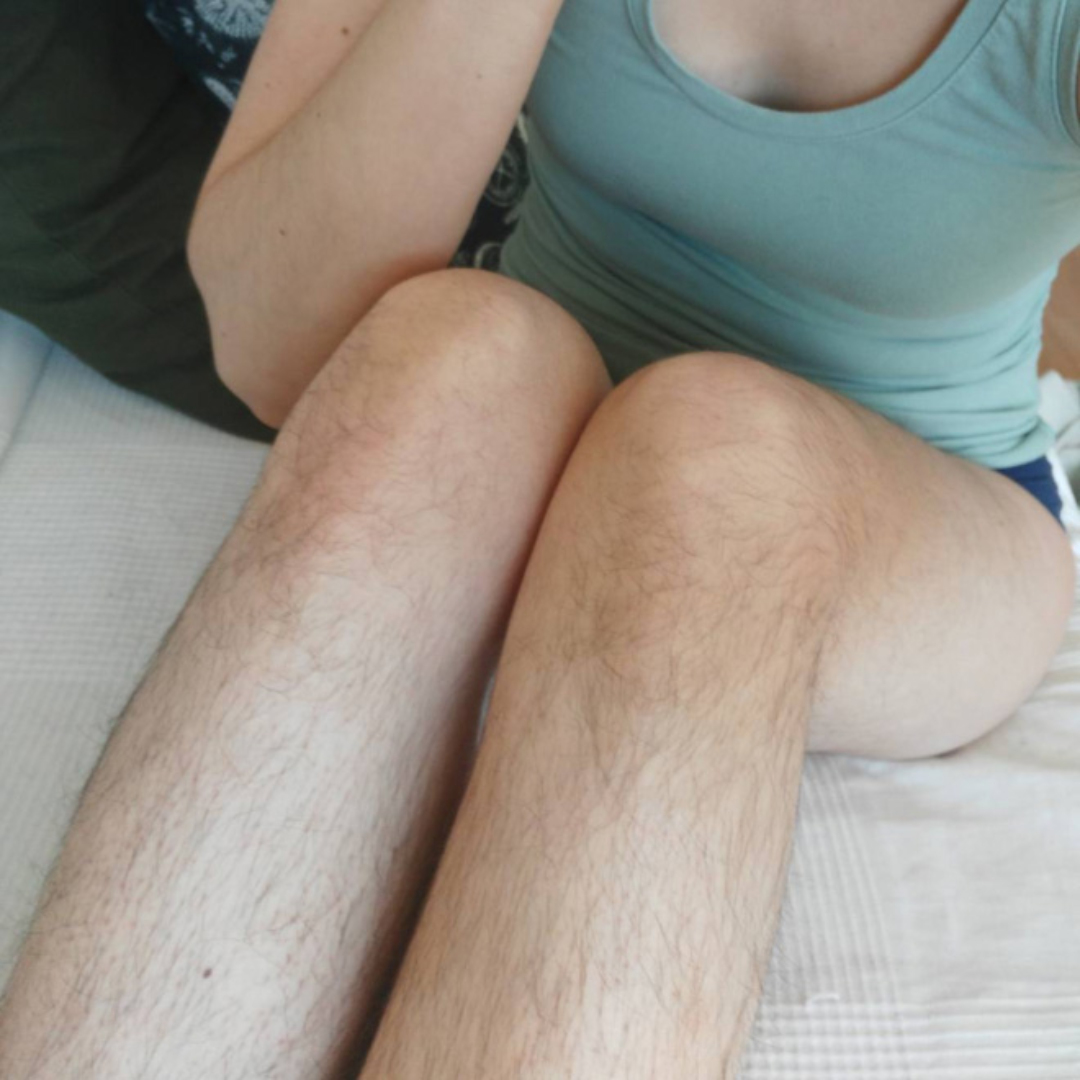 Before Hair Removal for Leg Hair at 4EvaGlow