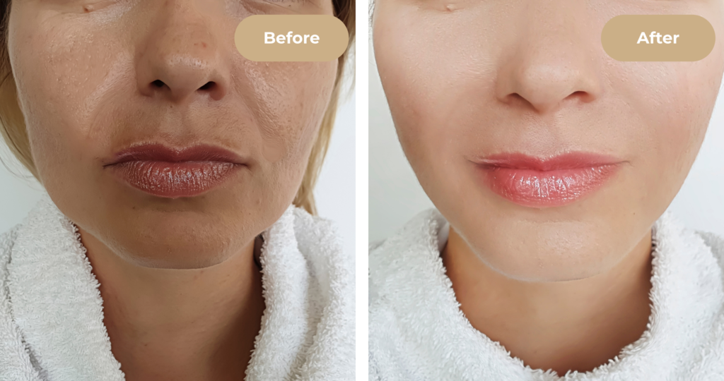 Client facial rejuvenation with dermal filler treatment