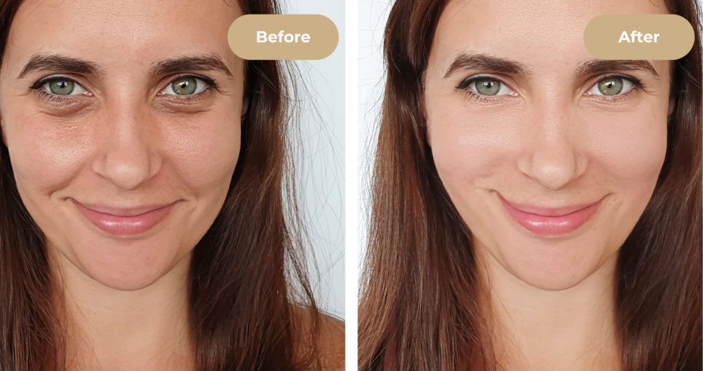 Before and after lip enhancement with dermal fillers at 4EvaGlow