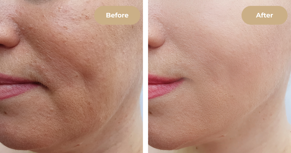 Volume restoration and contouring using dermal fillers