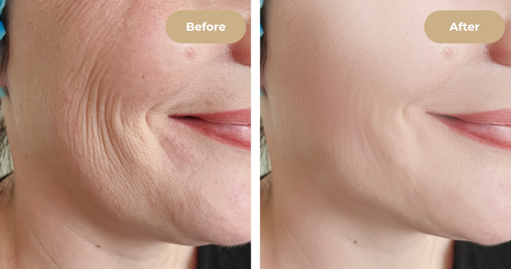 Client's skin transformation after Hydrafacial at 4EvaGlow