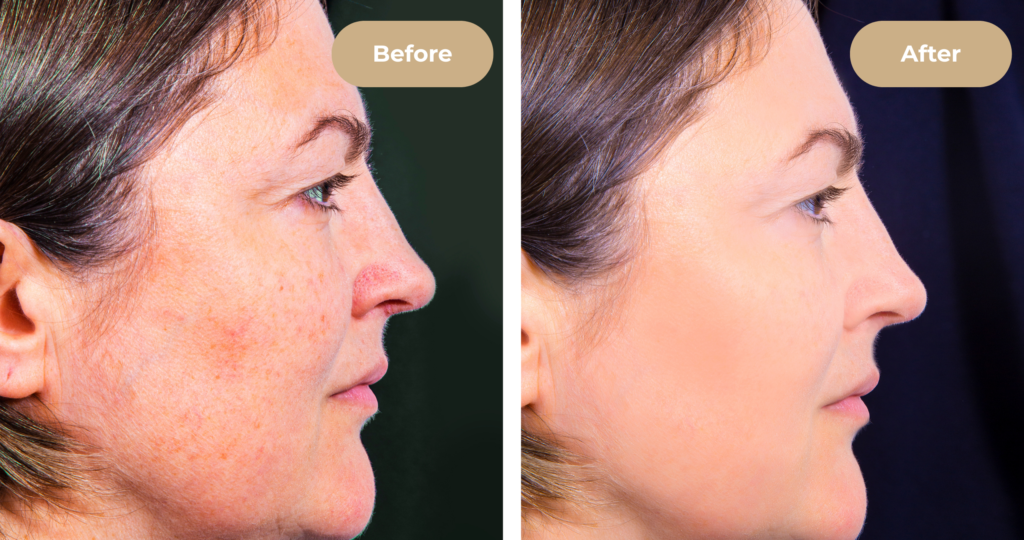 Hydrafacial results improving skin clarity and tone