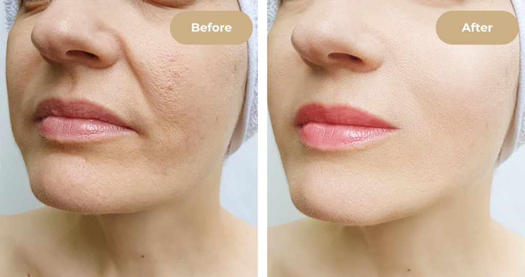 Skin texture improvement after microneedling at 4EvaGlow