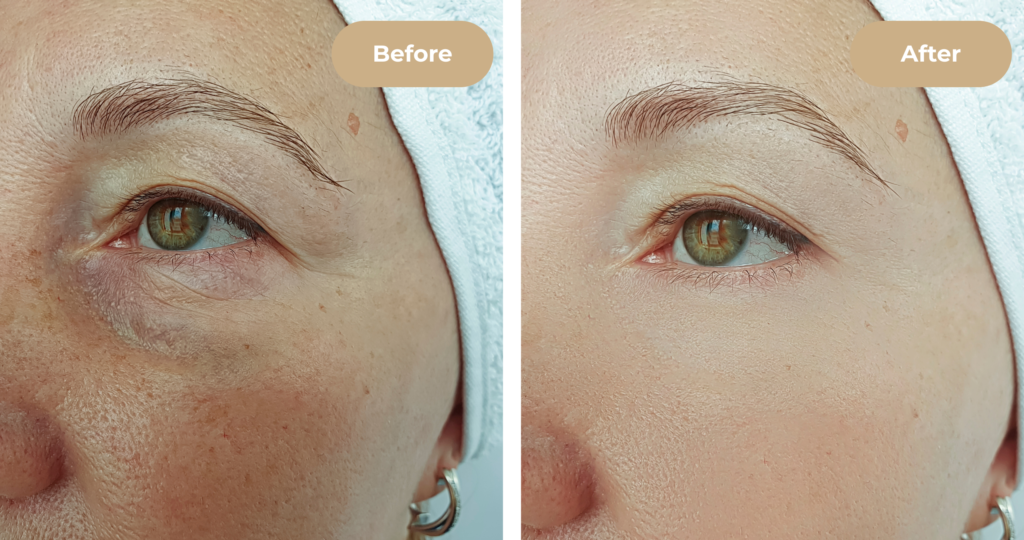 Before and after microneedling treatment for smoother skin