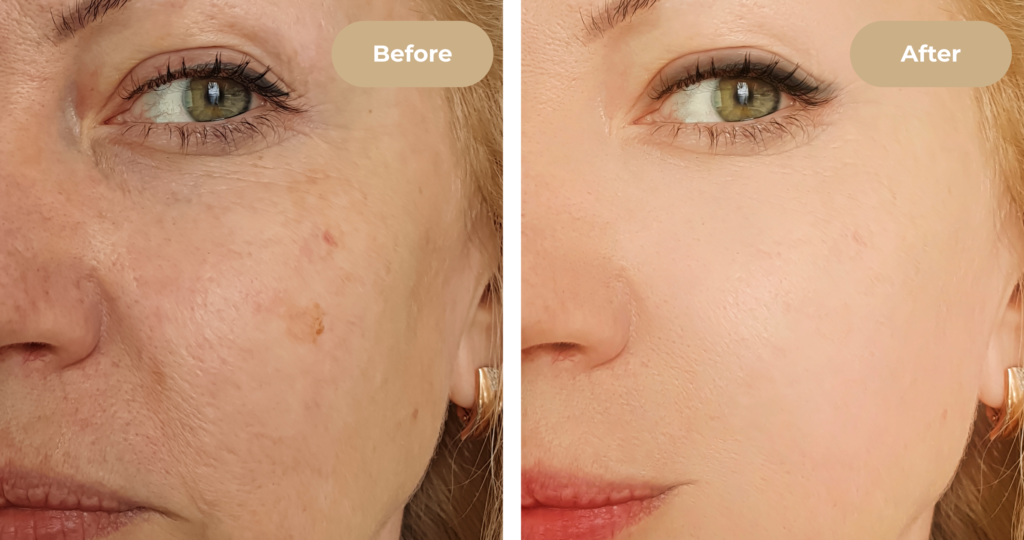 Skin texture improvement after microneedling at 4EvaGlow